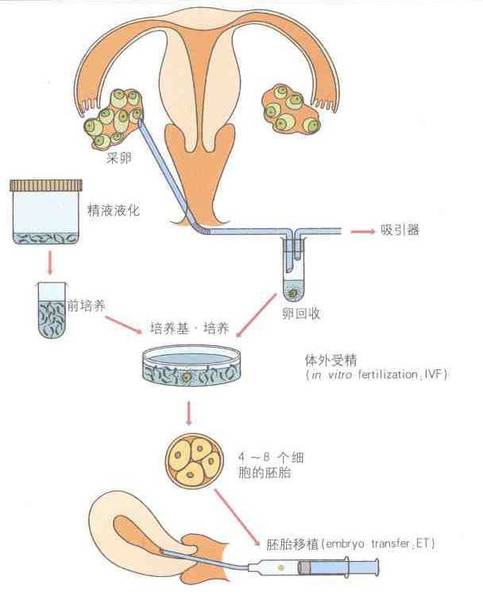 七年求子得龙凤胎供卵试管婴儿早产高额费用愁坏夫妻