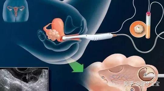 试管移植促排卵方案流程+促排卵移植方案的流程
